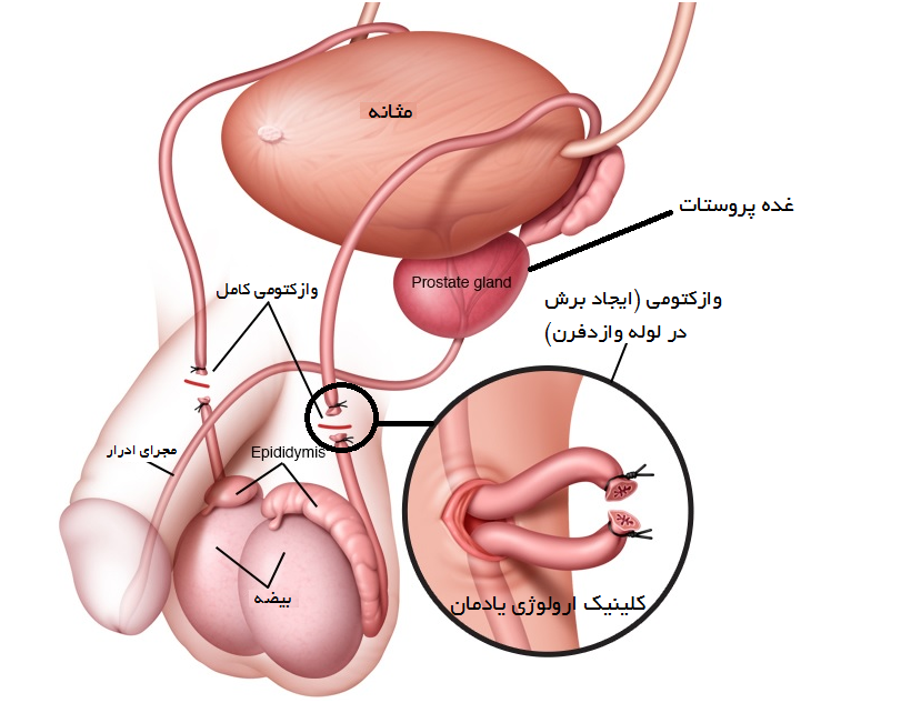 بستن لوله در مردان چه عوارضی دارد؟