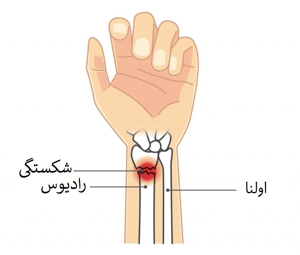 انواع درمان شکستگی دست و مچ دست