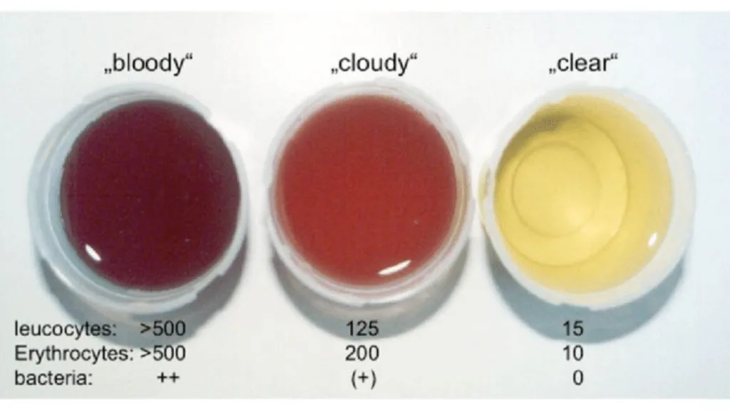 تشخیص هماچوری