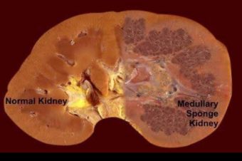 تصویر کلیه اسفنجی