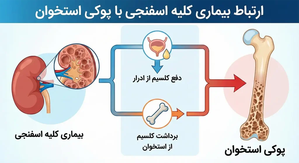 ارتباط بیماری کلیه اسفنجی با پوکی استخوان