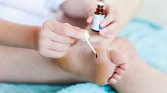 درمان زگیل و معالجات خانگی