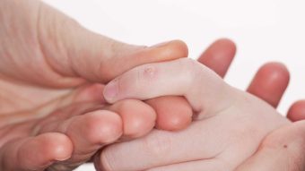 علائم زگیل های معمولی چیست