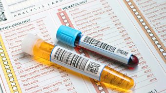 هماچوری یا خون در ادرار چیست؟