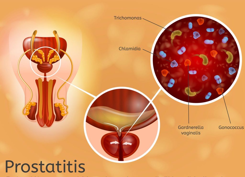 پروستاتیت