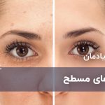 زگیل های مسطح