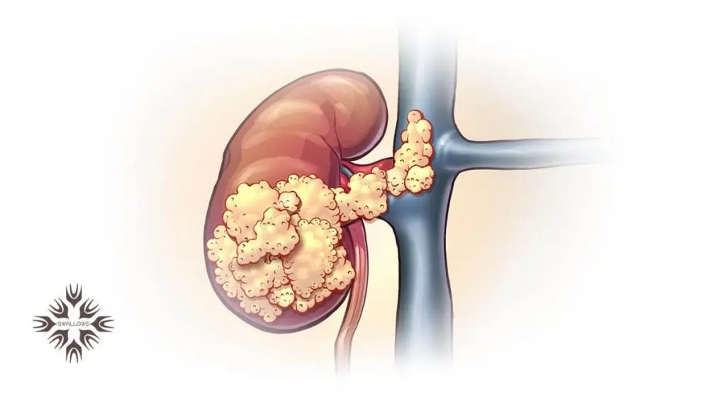 تشخیص آبسه کلیوی