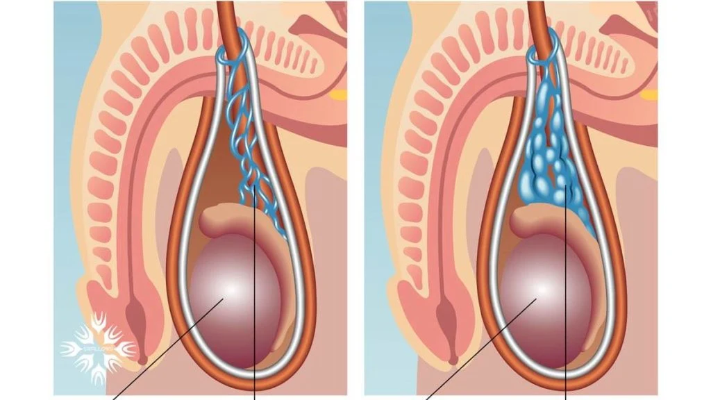 درمان اپیسپادیاس