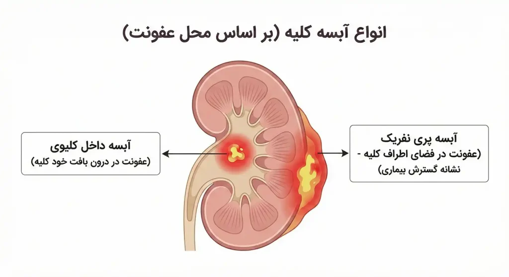 انواع آبسه کلیه