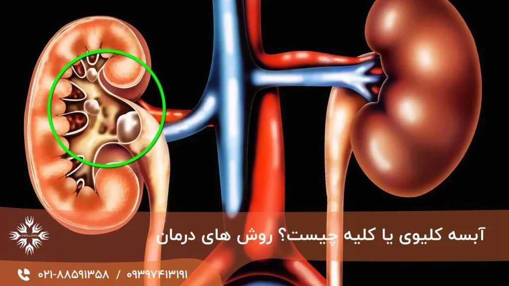 آبسه کلیه یا کلیوی چیست