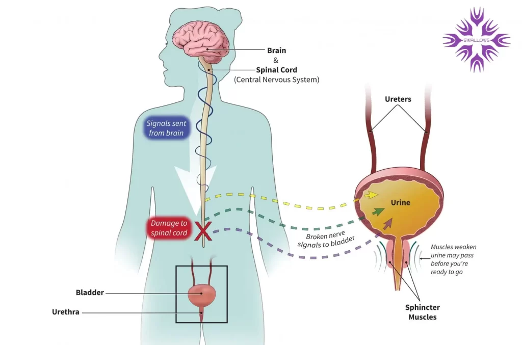  مثانه نوروژنیک و مشکلات سیستم عصبی