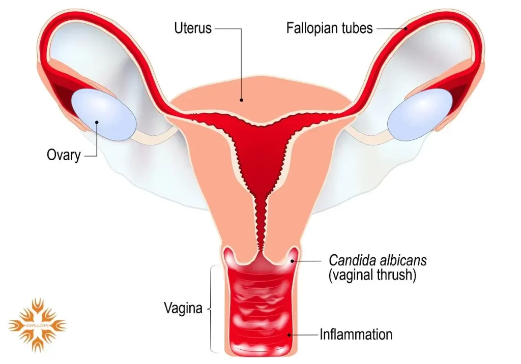 عفونت واژن