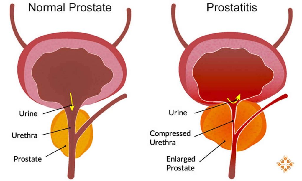 پروستاتیت