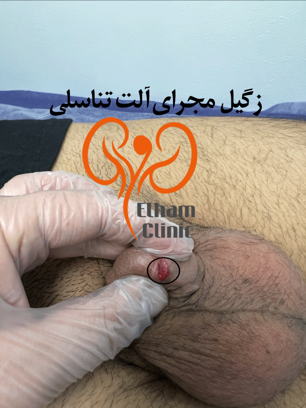 عکس بیماری پوستی دستگاه تناسلی مردان - زگسل مجرای ادراری