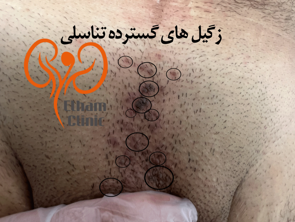 عکس بیماری پوستی دستگاه تناسلی مردان - زگیل تناسلی