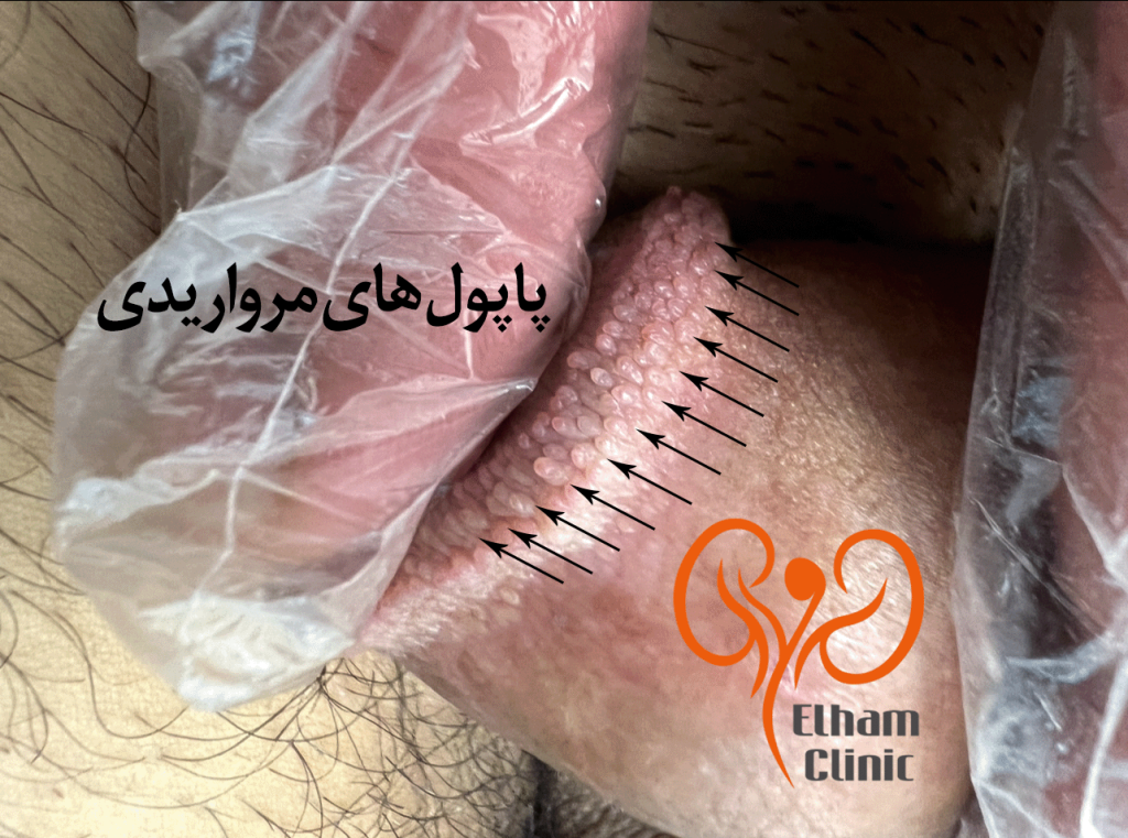 عکس بیماری پوستی دستگاه تناسلی مردان - پاپول مرواریدی