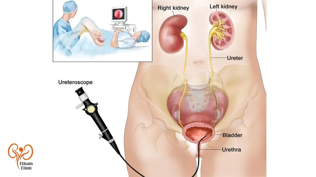 تشخیص تنگی مجرای ادراری