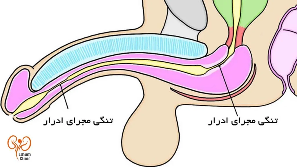 تنگی مجرای ادراری در مردان