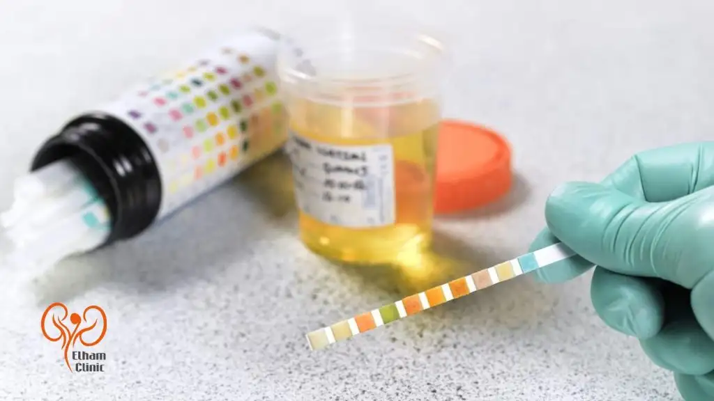 تشخیص پروتئینوری