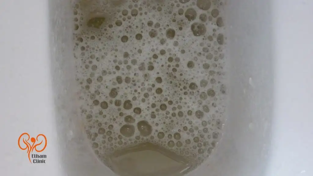 علائم پروتئینوری