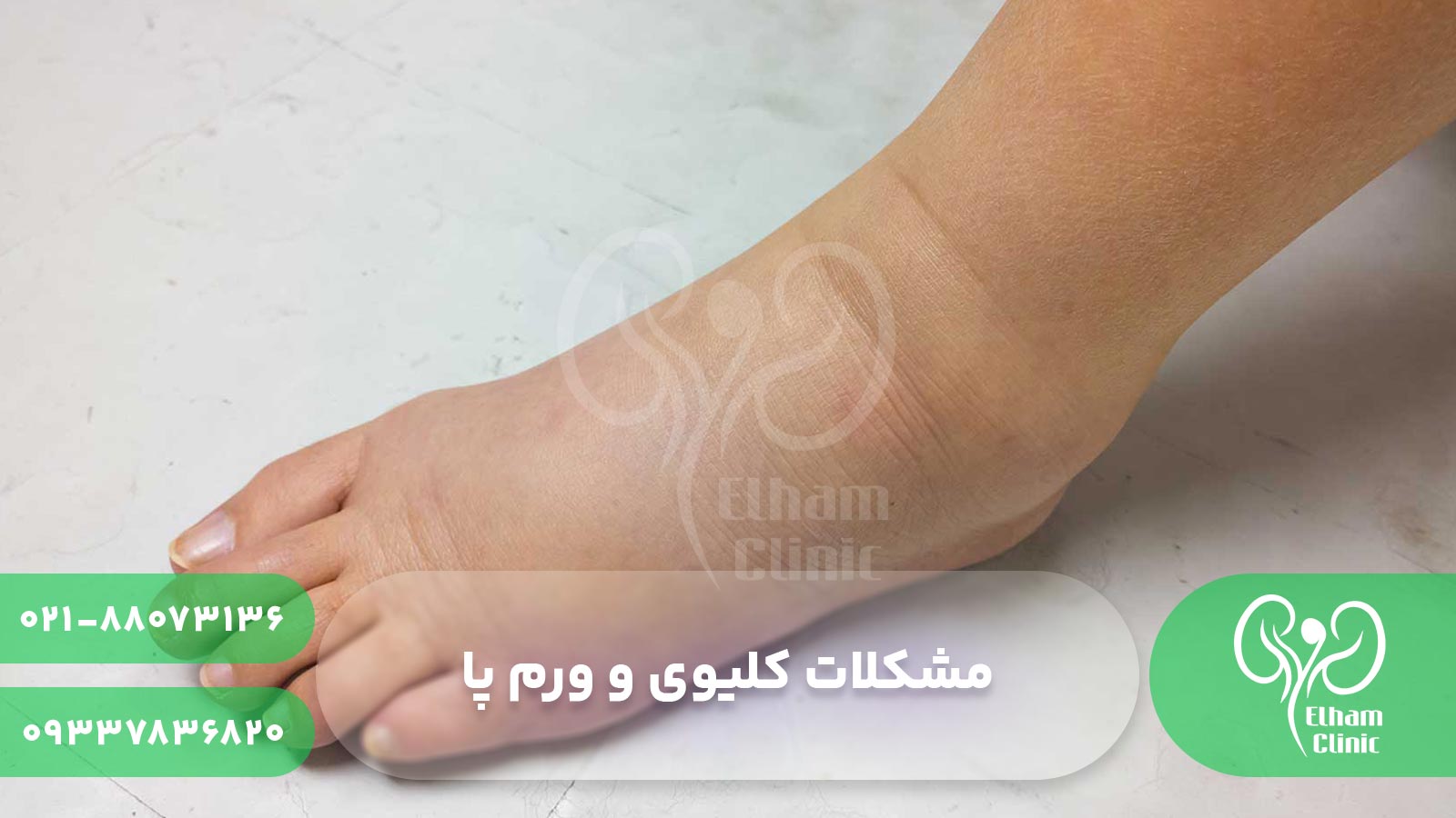 مشکلات کلیوی و ورم پا
