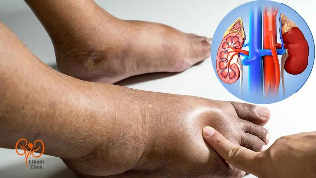 درمان ورم پا در بیماران کلیوی