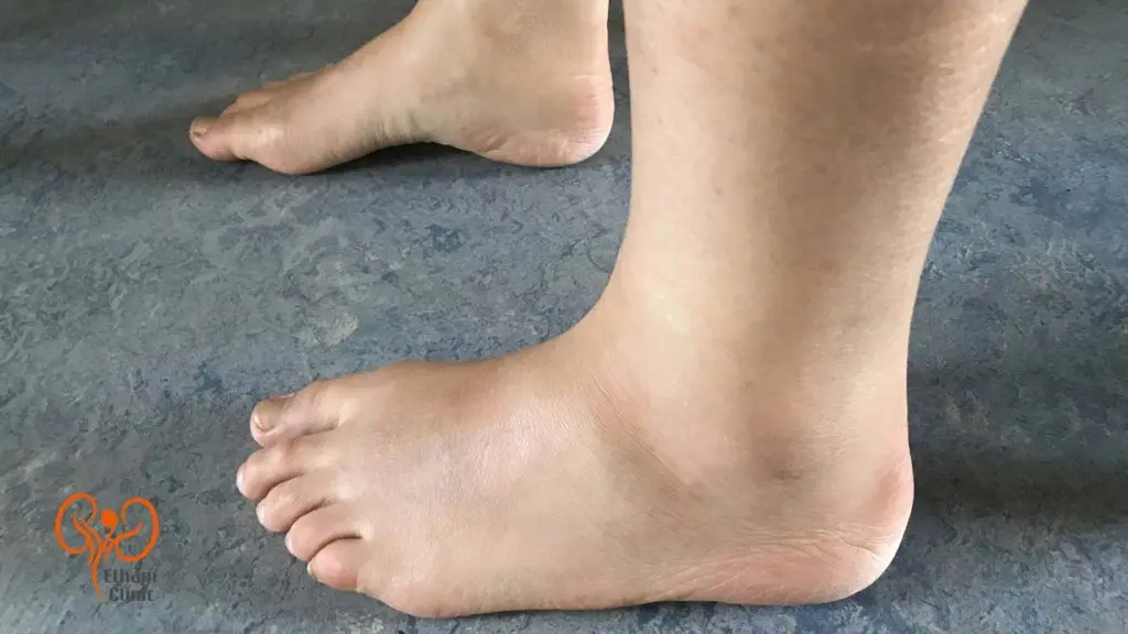 تشخیص علت ورم پا