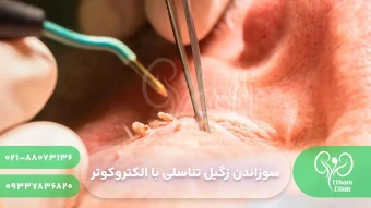 سوزاندن زگیل تناسلی با الکتروکوتر : [مزایا و معایب+توضیحات جامع]