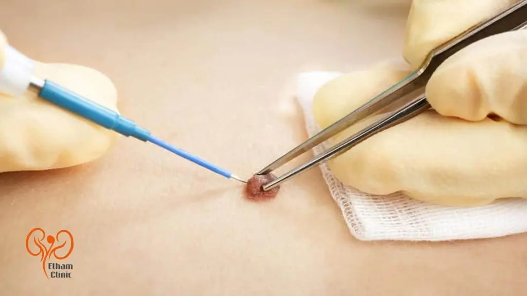 درمان زگیل تناسلی با الکتروکوتر