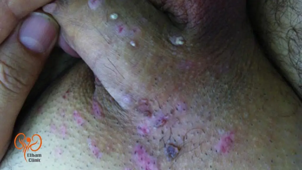 استفاده از الکتروکوتر برای برداشتن زگیل تناسلی