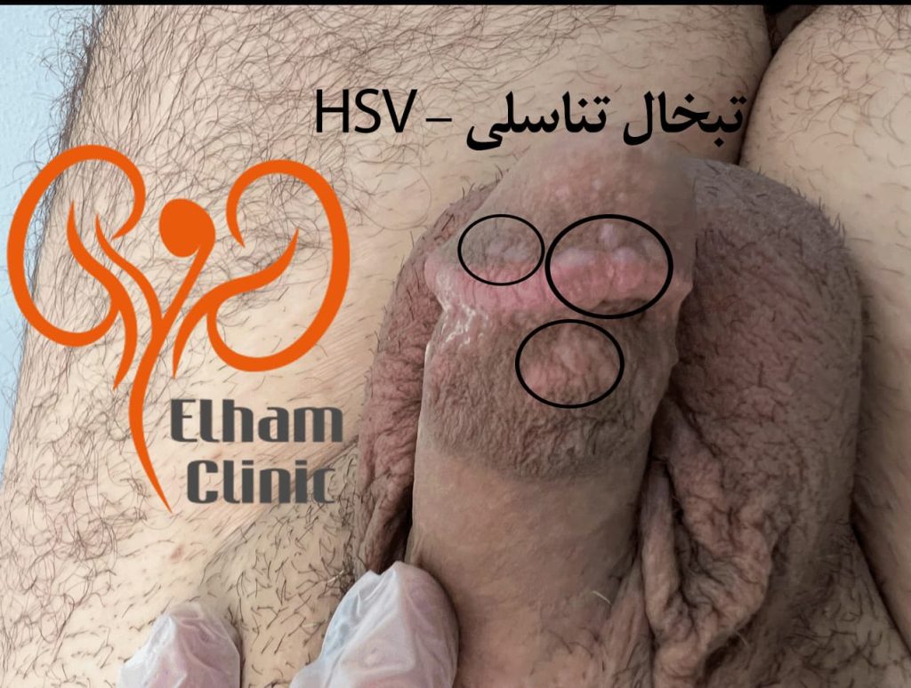 عکس بیماری پوستی دستگاه تناسلی مردان - تبخال تناسلی