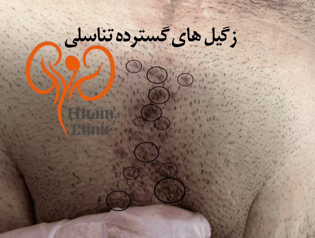 عکس بیماری پوستی دستگاه تناسلی مردان - زگیل تناسلی