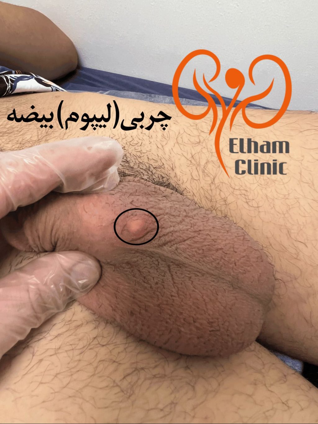 عکس بیماری پوستی دستگاه تناسلی مردان - چربی بیضه