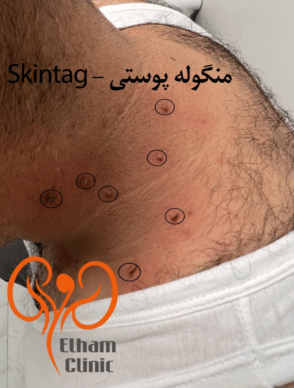 عکس بیماری پوستی دستگاه تناسلی مردان - منگوله پوستی