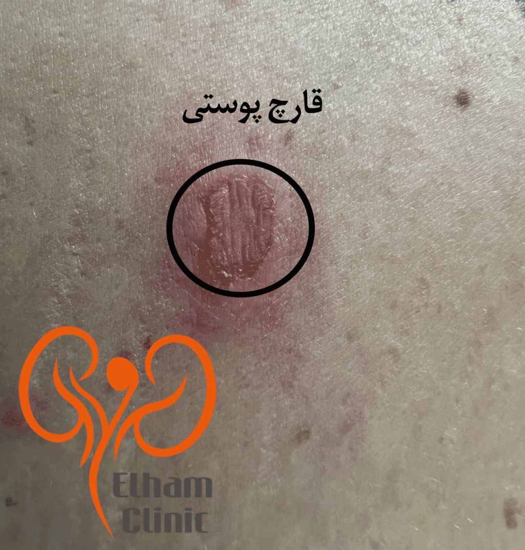 عکس بیماری پوستی دستگاه تناسلی - قارچ پوستی