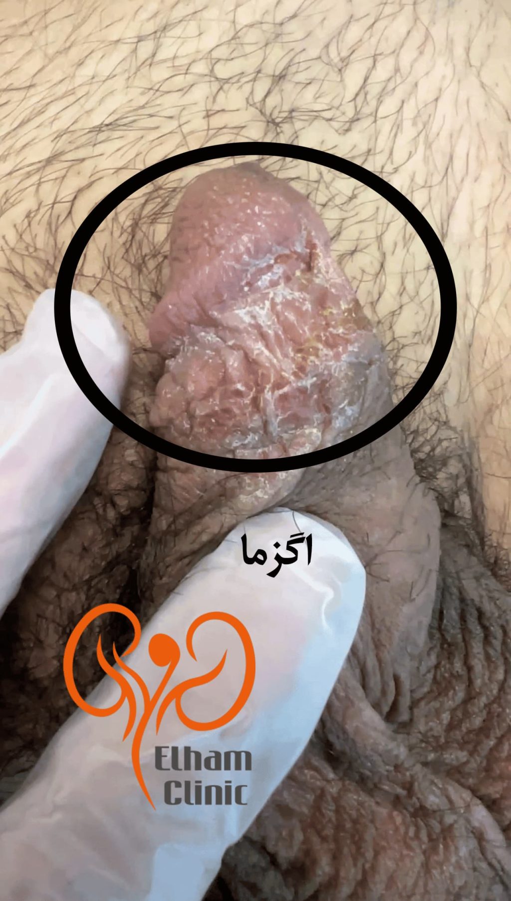عکس بیماری پوستی دستگاه تناسلی مردان - اگزما