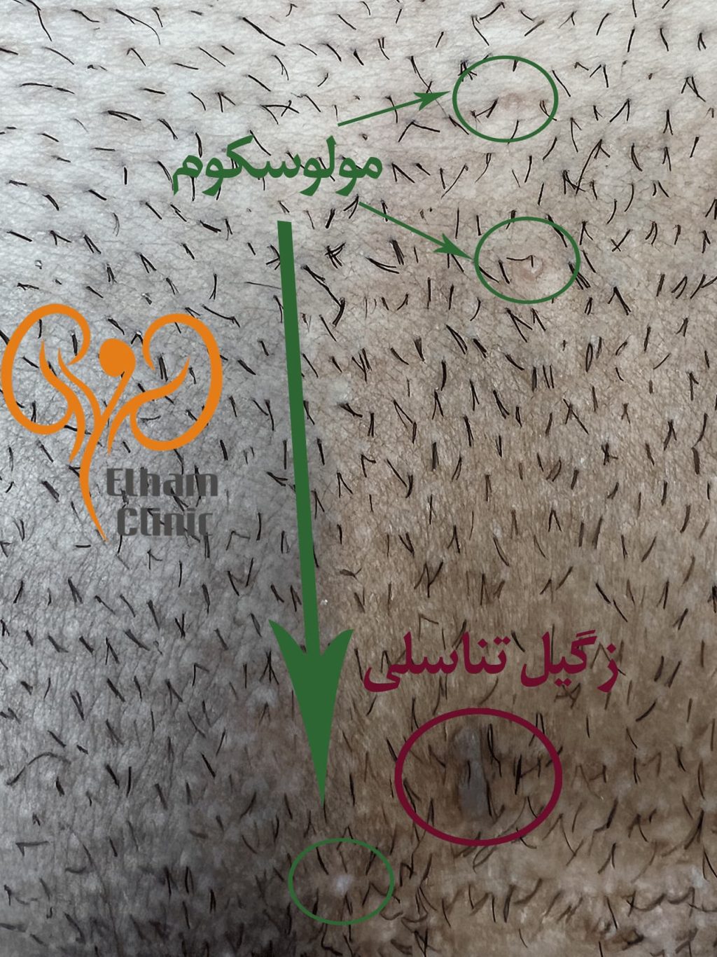 عکس بیماری پوستی دستگاه تناسلی - مولوسکوم