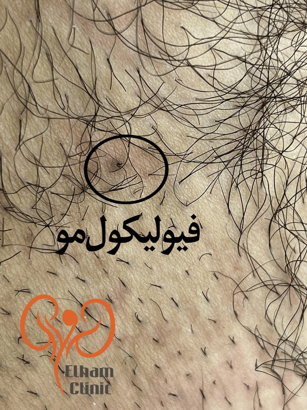 عکس بیماری پوستی دستگاه تناسلی - فولیکول مو