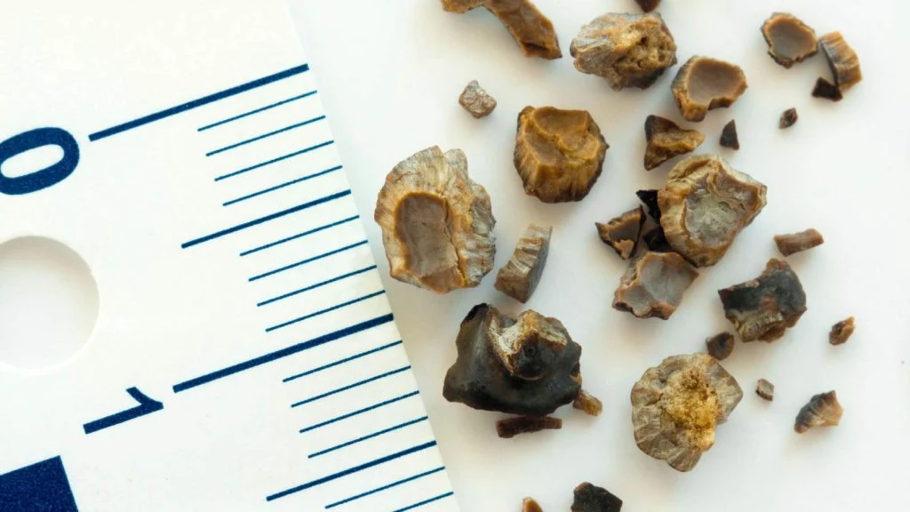 آزمایش و تشخیص سنگ کلیه