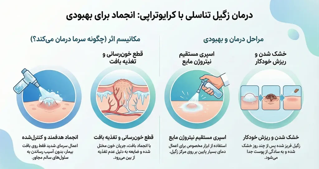 کرایوتراپی زگیل تناسلی چیست